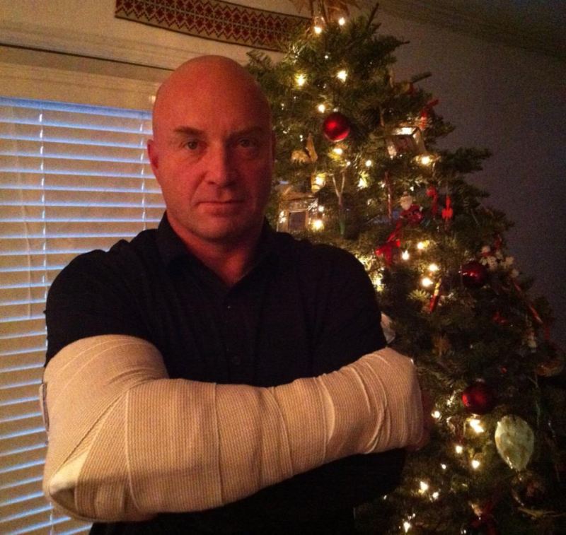 Todd Hutchings after surgery with gypsum